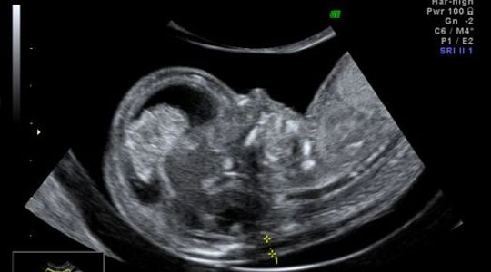 First Trimester