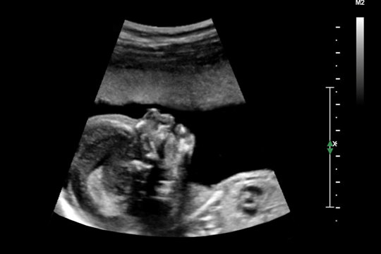 B1/2024 - Basis-Ultraschall für Gynäkologie und Geburtshilfe
